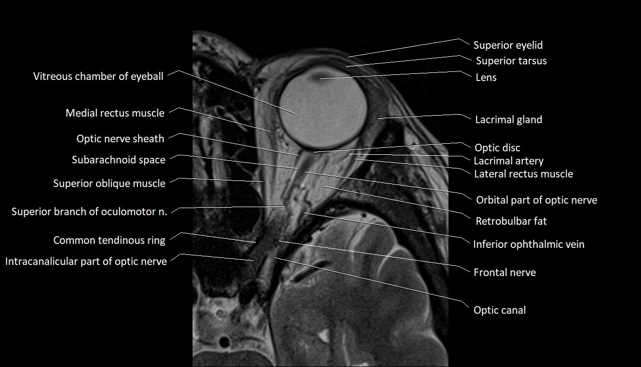 MRI Orbit axial cross sectional anatomy image 9.webp